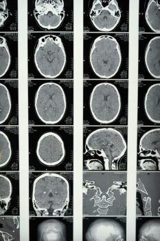 maladie de Charcot