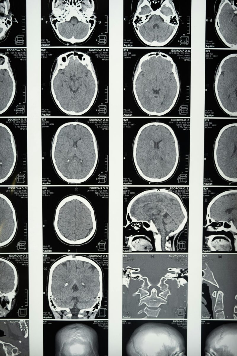 maladie de Charcot